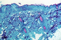 サル痘、12カ国で92人確認　今後も増加へ＝ＷＨＯ